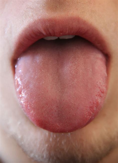 Burning Tongue: 9 Causes, One Life-Threatening » Scary Symptoms
