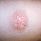 Small numbers of this germ commonly live on the skin, and do no harm. Pityriasis versicolor, zomergist: symptomen en behandeling ...