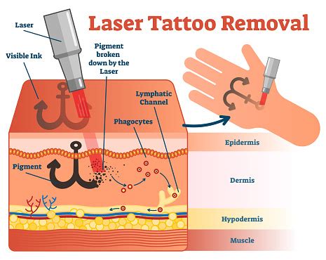 Again, these are companies that are involved in all aspects of minimally invasive cosmetic treatments, which is riding a huge demographic trend. Laser Tattoo Removal Vector Illustration Diagram Stock ...