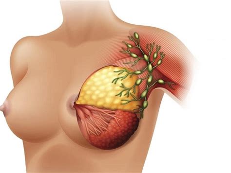 Arpit gohli's heart developed outside his rib cage. Nguyên nhân nổi hạch ở nách trái