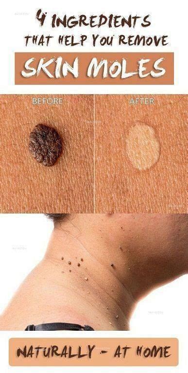 Ideally this will cause the mole to shrink or fade. Best Remedies to Get Rid of Skin Tags Naturally | Skin ...