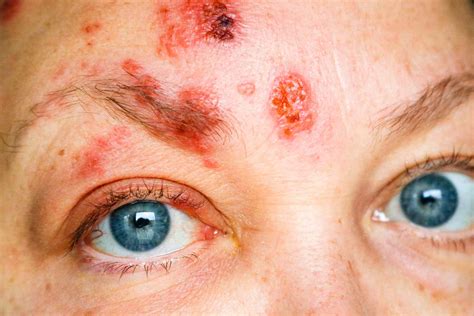 Pictures Of Shingles On Your Face - itiscouragethatcounts