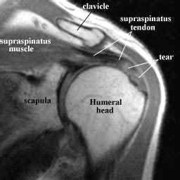 The supraspinatus muscle and tendon both pass deep to the acromion process to insert on the super facet of the greater tuberosity of the humerus muscles and fascia of the shoulder, supraspinatus, scapula, humerus, deltoid, infraspinatus, teres minor and major, latissimus dorsi, triceps brachii. supraspinatus-muscle-and-tendon-mri.jpg (256×256 ...