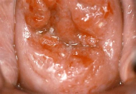 Cervical cancer is an abnormal growth of cells that originates from the cervix. Minimally invasive laparoscopic surgery for early-stage ...