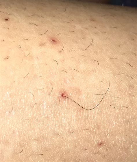 What do ingrown hairs look like? My sisters home from college and she had the LONGEST ...