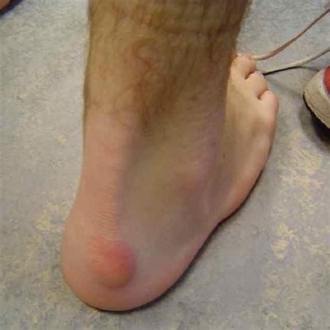 In the foot we have a unique situation in that between the shoes that we wear, and the ground that we walk. 47 best Bursitis images on Pinterest | Banting diet, Bones ...