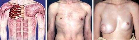 Poland syndrome with bilateral features: Poland's Syndrome | Thoracic Key