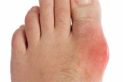 Подагра фото симптомы причины Подагра фото симптомы причины