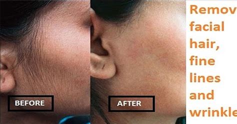 This method gives you the long lasting result and is quite simple, in. Best way to remove facial hair, fine lines and wrinkles ...