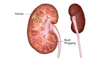 Anda punya masalah tentang pembuangan air kencing(urine). Kanser Buah Pinggang: Punca, Simptom dan Rawatan - The ...