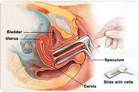 It tests for the presence of precancerous or cancerous cells on the cervix. Hanimku Sofiyya: PAP Smear