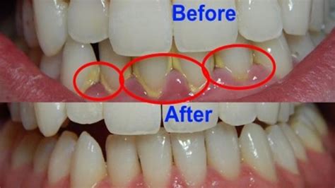 Plak yang masih tipis dapat dihilangkan dengan rutin menyikat gigi dan membersihkan gigi menggunakan benang (flossing). Ini Dia Cara Baru Hilangkan Karang Gigi - Tribun Sumsel