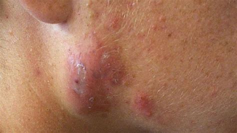 Types of acne with pictures and treatment. Types of Acne: Pictures, Treatments, and More
