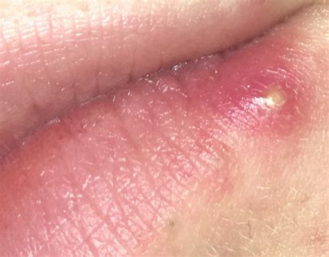 Wunde innere schamlippen können viele ursachen haben. Pickel An Der Lippe Innen / komisches bläschen auf der ...