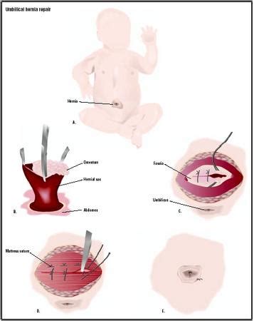 A supraumbilical hernia is the result of a defect just above the umbilical ring muscle. Umbilical hernia repair. Causes, symptoms, treatment Umbilical hernia repair