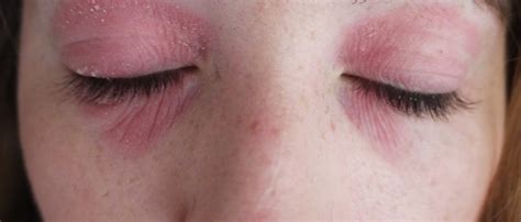 A condition called contact dermatitis develops when something that touches your. How I Got Rid of my Eye Eczema. | Lux Life London