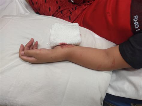 Compound fracture my son received at the local skating ...