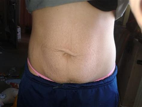 Meiner erfahrung nach macht die schwellung aber keinen unterschied von einer ganzen körbchengröße. Brust- & Bauchstraffung! Risiken?? Kosten?? Ab wieviel ...