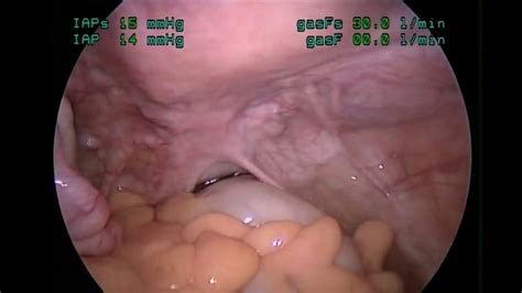 Elle est liée à la présence de tissu semblable à la muqueuse utérine en dehors de l'utérus. Laparoscopie Endométriose - YouTube