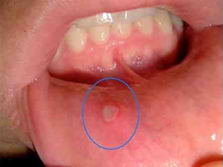 Herpes on tongue comes only when herpes is in the full mouth. How You Get Oral Herpes For Infection Skin Yeast Medication | CONTAGIOUS COMPOSITION GO4SEM