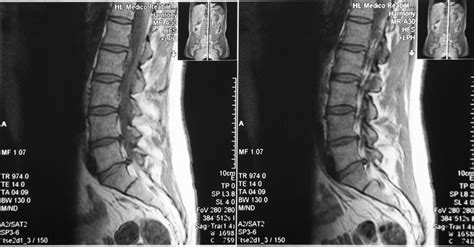 A herniated disc occurs when one of the rubbery pieces of cartilage between the vertebrae ruptures or slips out of place. Bodi Empowerment - Dr Ken Nakamura Downtown Toronto ...