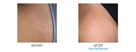 However, if you get wax treatments regularly for years, it can end up costing you even more than laser treatment. Laser hair removal