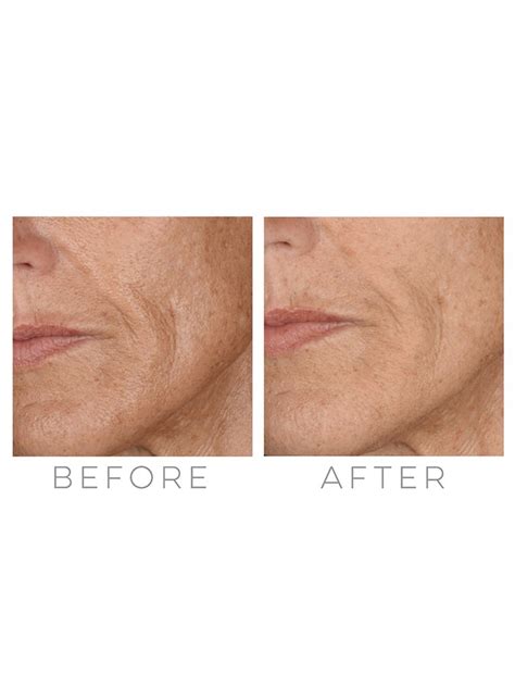 Microneedling is a minimally invasive cosmetic treatment that involves puncturing the skin using fine needles or dermaroller to boost your skin's collagen production. Shedding Microneedling - Hair Shedding Scale Scores Vary Between 1 Minimal Shedding To 6 ...