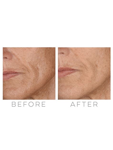 Microneedling is a minimally invasive cosmetic treatment that involves puncturing the skin using fine needles or dermaroller to boost your skin's collagen production. Shedding Microneedling - Hair Shedding Scale Scores Vary ...