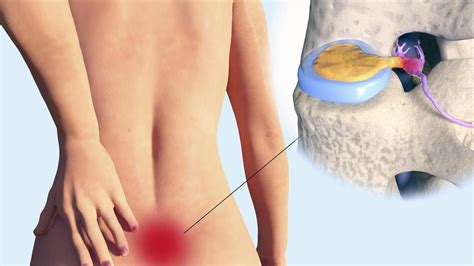 Welche symptome verursacht ein bandscheibenvorfall, wann ist eine operation notwendig, und welche weiteren möglichkeiten zur behandlung gibt es? Rückenschmerzen: Wann ein Bandscheibenvorfall zum Notfall ...
