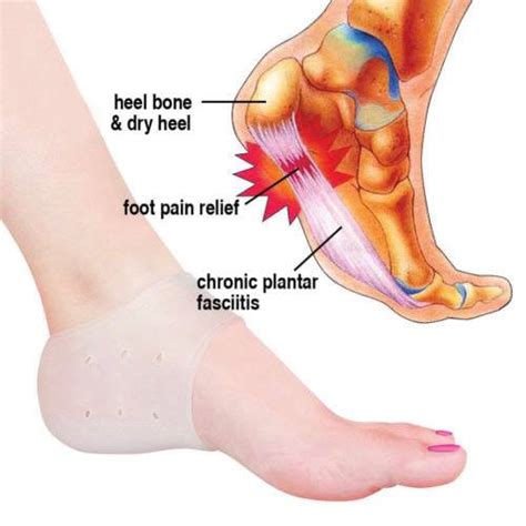 Jika saraf berkenaan dihimpit atas beberapa sebab maka ia. PLANTAR FASCIITIS / SAKIT TUMIT / SAKIT TAPAK KAKI / HEEL ...