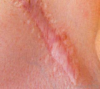 What are some home remedies for eczema? Most effective acne treatment 2013, how can i get rid of ...