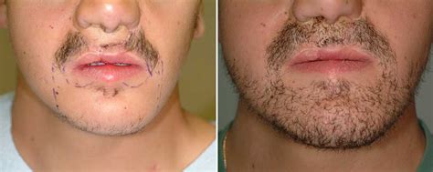 Pubic hair fills out, reaching the inner thighs. The Many Stages Of Growing Out Facial Hair :: FOOYOH ...