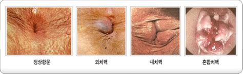 (혈전성 외치핵) 탈출한 치핵의 색이 까맣게 변해 있으며 통증이 있다. :::하나로네트워크 한의원에 오신 것을 환영합니다.:::