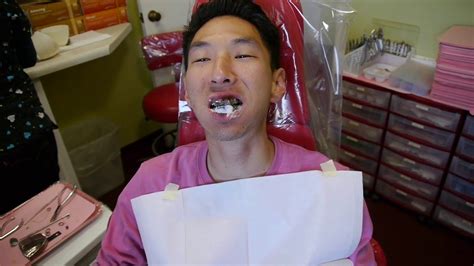 Foods to eat when you first get braces/ tightened. Vlog #16: Getting The Impressions For My Braces! - YouTube