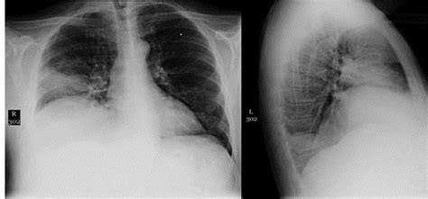 Empyema is defined as the presence of pus in the pleural space. SOUTHWEST JOURNAL of PULMONARY & CRITICAL CARE - Pulmonary ...