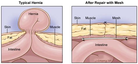 This is why pregnancy is also a risk factor for hernias. HERNIA