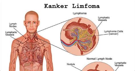 Karena itu, selayaknya kanker payudara. Mengenal Kanker Ganas, Limfoma - Warta Pilihan