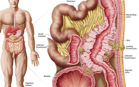What is the diagnosis code for diverticulitis? Diverticular Disease (Diverticulosis And Diverticulitis)