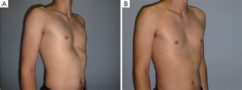 It is characterized by a sunken in sternum that makes pec development very challenging. Pectus excavatum repair from a plastic surgeon's perspective