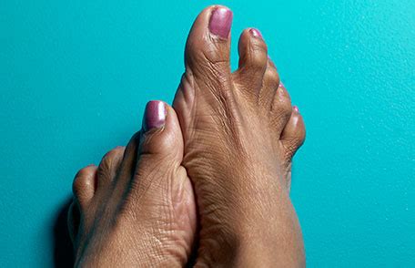 Learn more about your condition and possible remedies for relief. Living with Diabetes: Keep Your Feet Healthy| Features | CDC