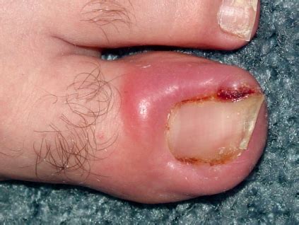 Learn all about ingrown toenails, the removal process how long do i keep the bandage on after ingrown toenail removal? Ingrown nail office care - Tyler, TX | Podiatrist