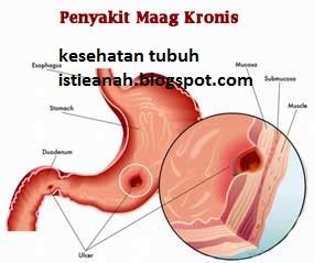 Penyakit maag apabila sudah pada tahap kronis sebetulnya adalah kondisi lanjutan dari penyakit maag yang sebelumnya sudah terjadi namun tidak memperoleh penanganan yang benar. 2Cara menyembuhkan penyakit maag secara tradisional