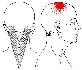 We did not find results for: J'ai tout le temps mal de tête et des douleurs cervicales ...