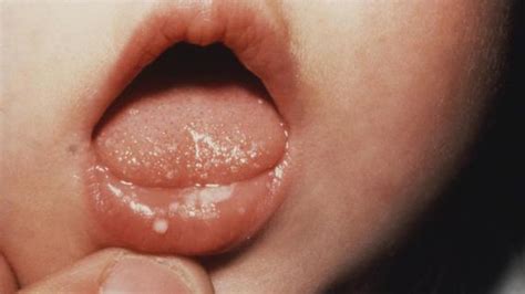 Namun lidah putih pada bayi juga bisa jadi penanda infeksi jamur. Mengapa Lidah Bayi Putih ? Begini Penyebabnya - MHomecare