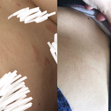 My Pityriasis Rosea Story; (Picture of healing included ...
