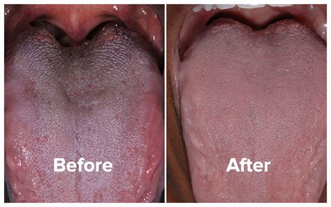 Make note of your symptoms to alleviate this in some cases this can become a white coating that covers the whole tongue. Patient Success Stories | National Breath Center