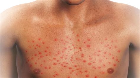 Cold symptoms are usually milder than the symptoms of flu. full body rash in adults - pictures, photos