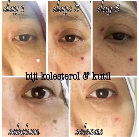 For more information and source, see on this link : Cara Hilangkan Biji Kolesterol Di Muka - sanx-xox