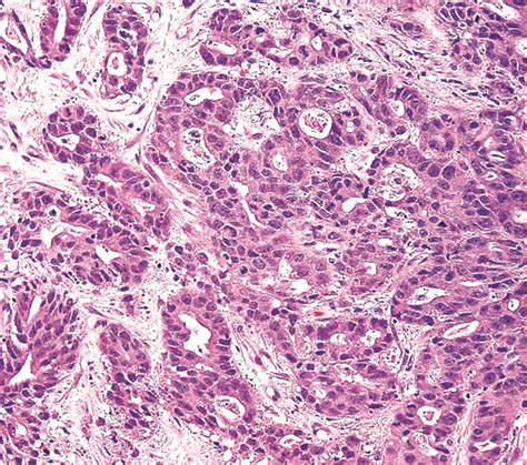 Pathology reports are what pathologists produce when finishing a case. Pathology Outlines - Adenocarcinoma