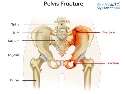 There many organs that located on the right side under the lower ribs. Pelvis Fracture | Rehab My Patient